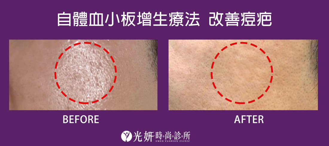 自體血小板增生療法
