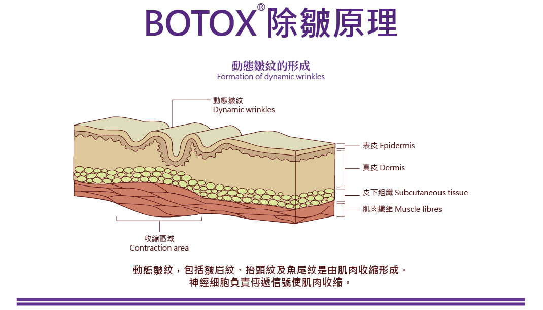 肉毒桿菌素注射 圖片 4