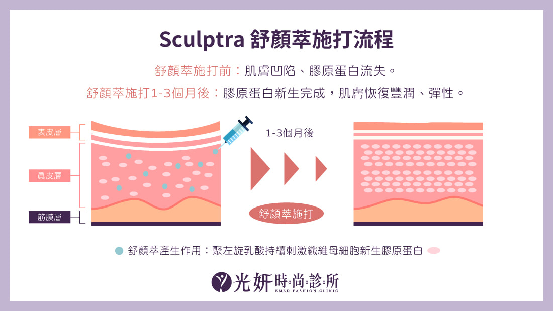 舒顏萃Sculptra® 圖片 6