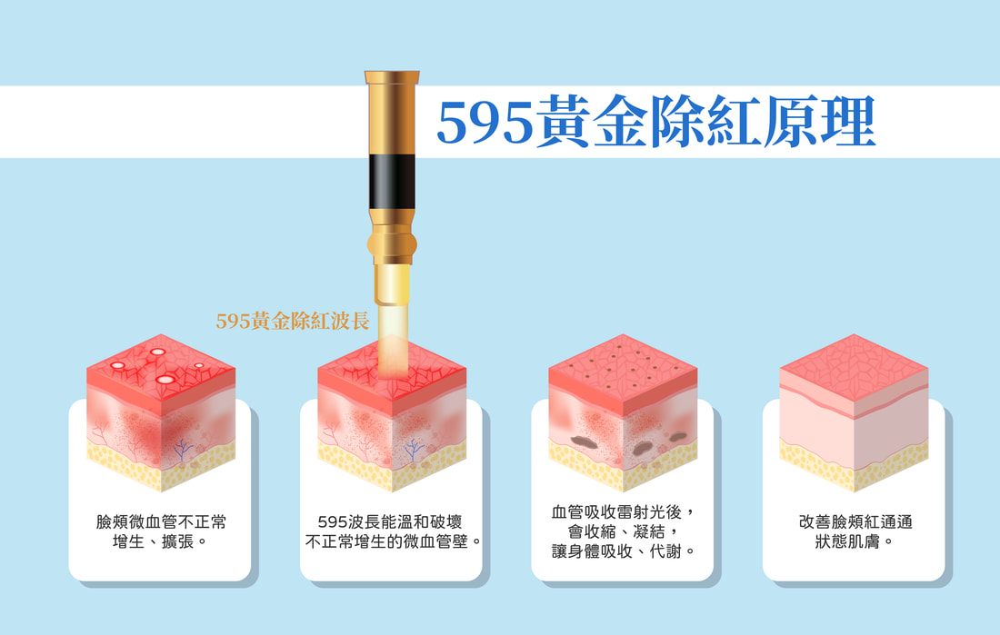 4D皮秒雷射 圖片 4