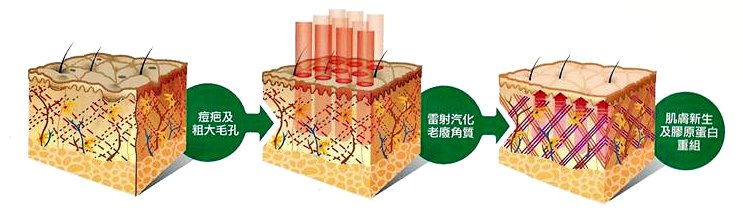 飛梭雷射 圖片 2