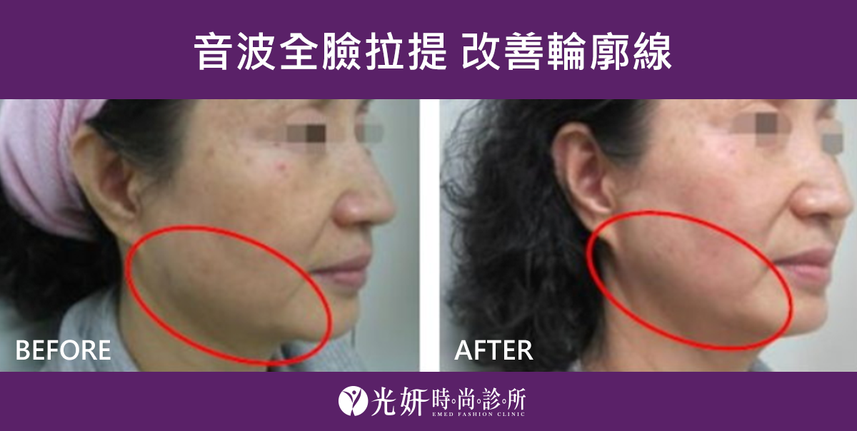 音波全臉拉提 改善輪廓線 圖片 1