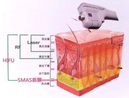 倍提無創音波拉皮 圖片 4