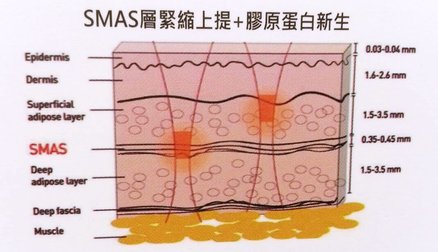 倍提無創音波拉皮 圖片 5